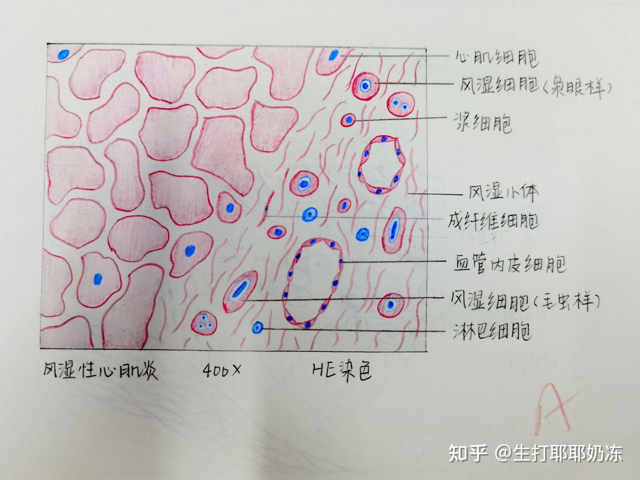 病理红蓝铅笔绘图