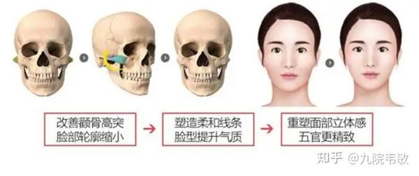九院韦敏说,颧弓颧骨整形热门问答(二) - 知乎