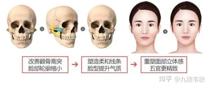九院韦敏说,颧弓颧骨整形热门问答(二) - 知乎