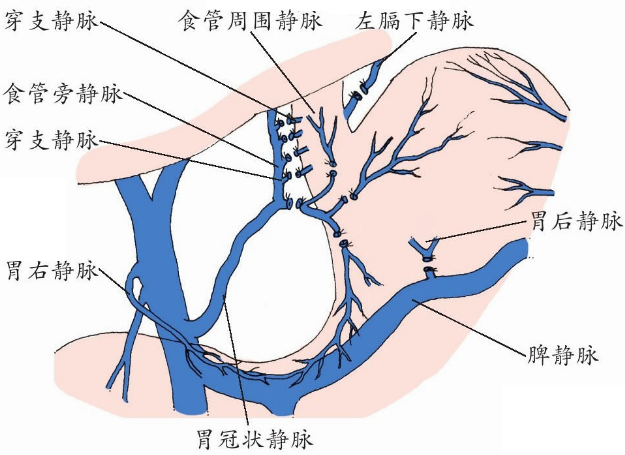 门脉高压症是什么病需要手术治疗吗