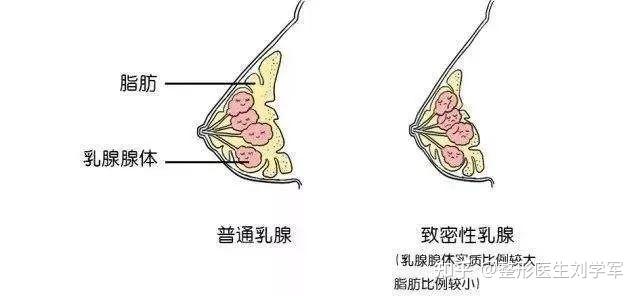 二,乳腺型乳房