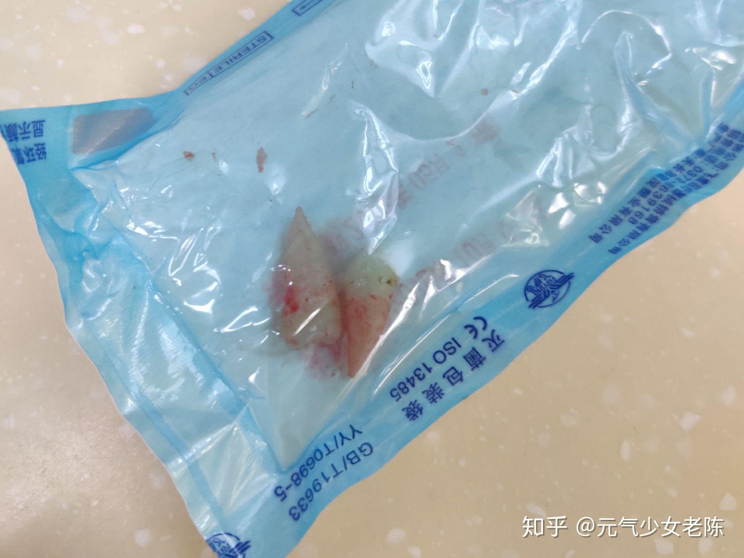 正畸拔牙是種怎樣的體驗你們做牙齒矯正花了多少錢