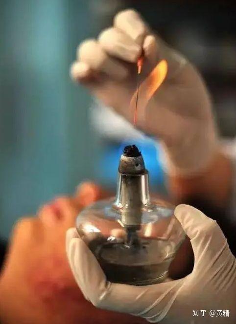 火针疗法可以治疗牙痛吗