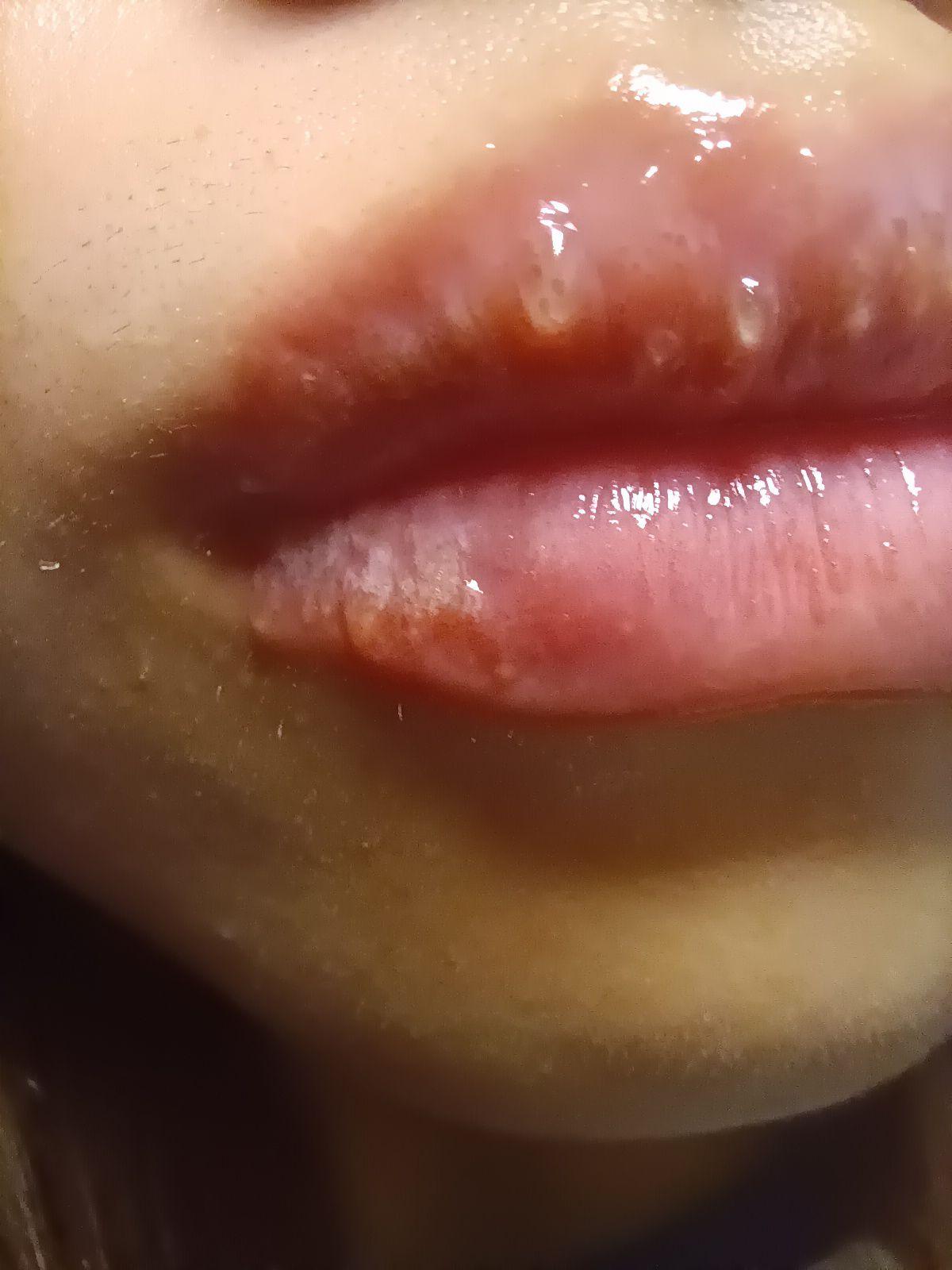 唇膏过敏性唇炎图片(唇膏过敏性唇炎图片高清)