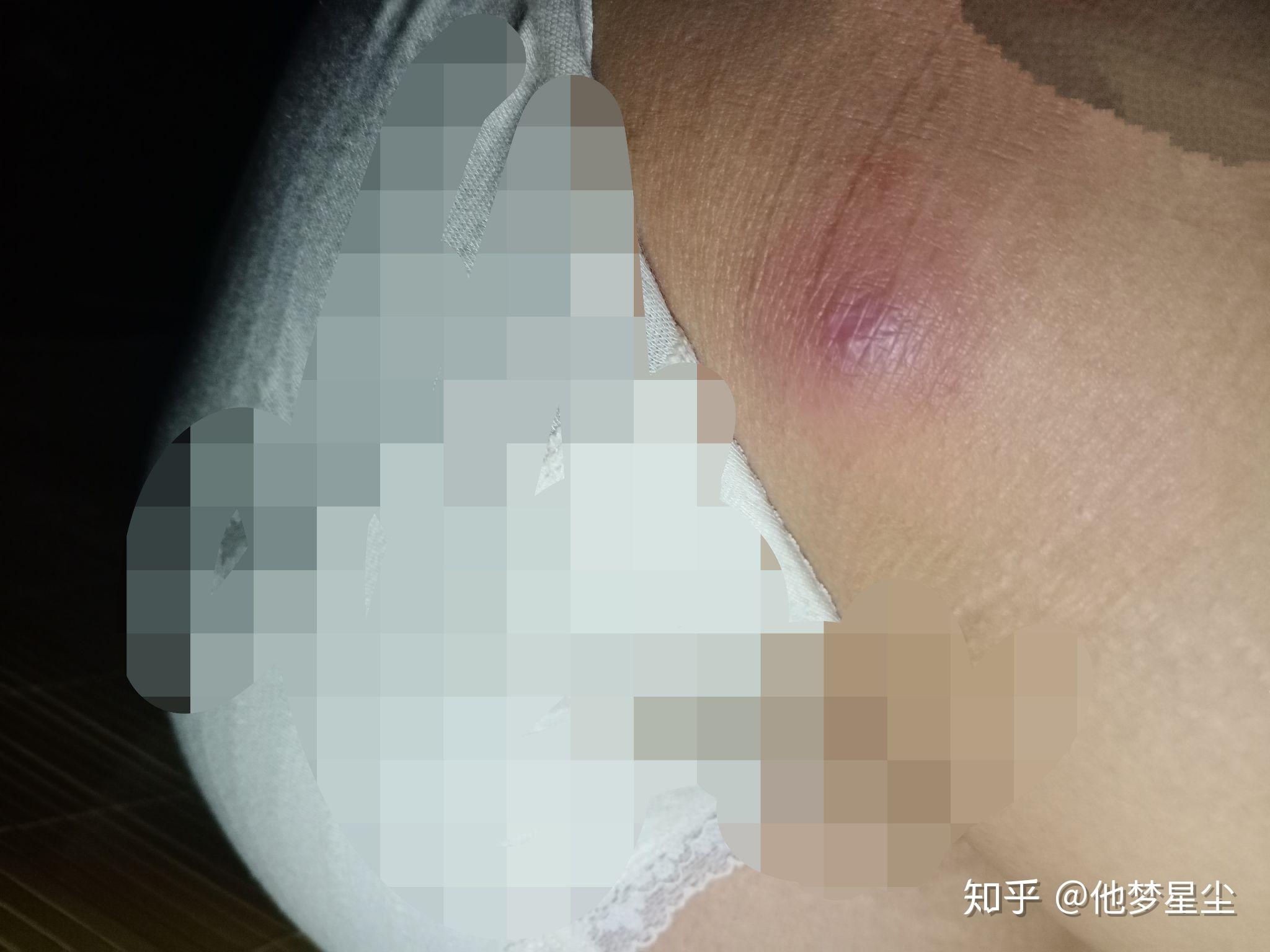 大腿根部不知道生了什么东西.摸起来有一点点痛.很硬硬的
