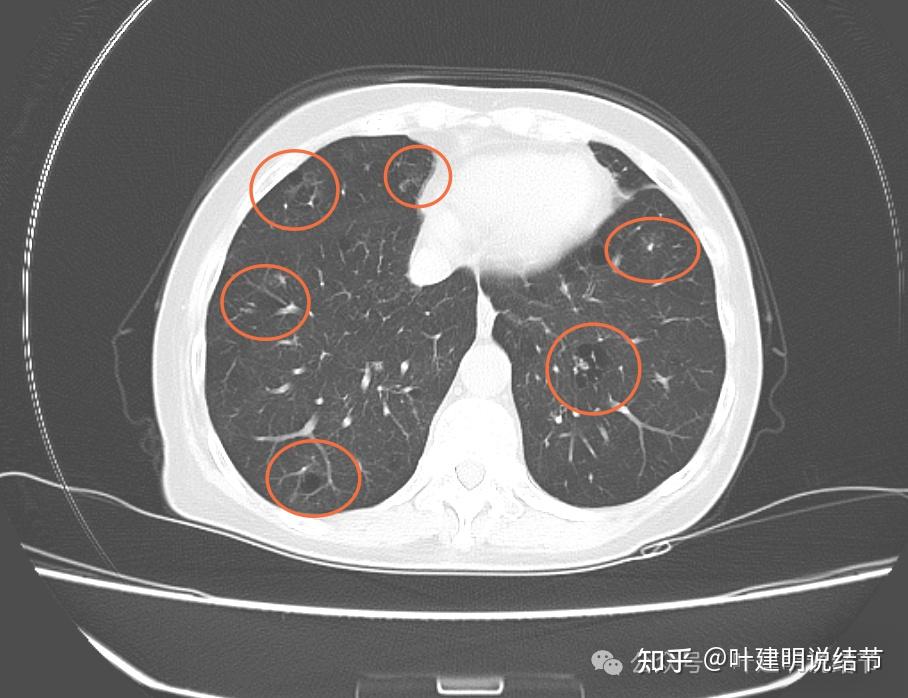 跨国问诊来自澳大利亚的肺结节问诊