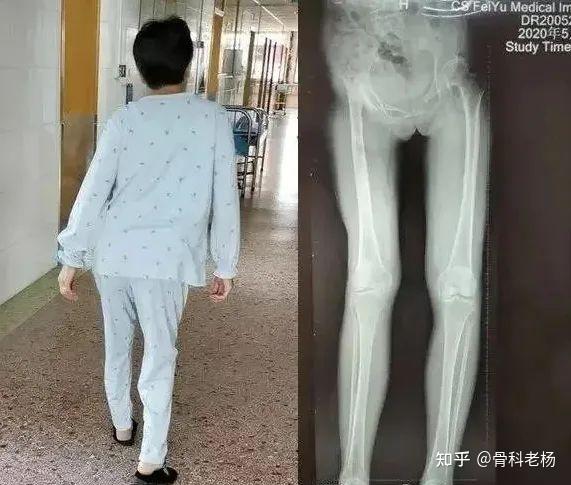 股骨头坏死病情晚期的主要症状,以及有效治疗方法推荐