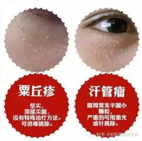 脂肪粒、栗丘疹、汗管瘤怎区分? 其实看完本文就一目了然! - 知乎