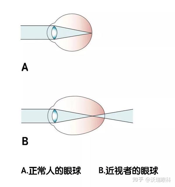 高度近视是不是眼轴超过28 45岁后就会失明 眼轴变长会引起失明吗 茶文网