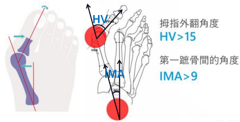 什么是拇外翻？有没有人做过大脚骨（拇指外翻）的手术，效果怎么样？有没有后遗症？医院医生有哪些推荐？ - 知乎