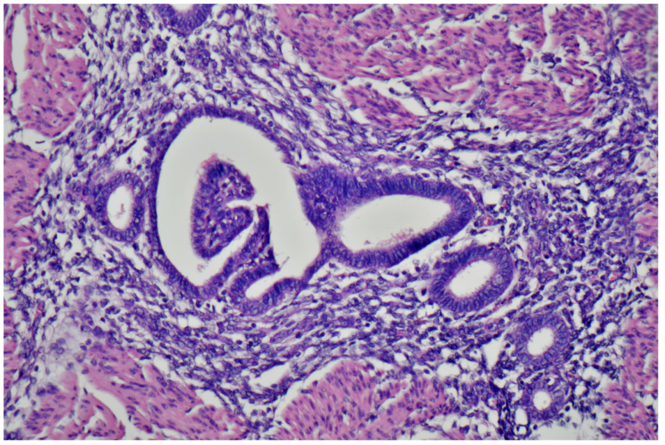 子宫内膜异位症罕见病例:无痛便血3个月并不断加重,反复结肠镜检查无