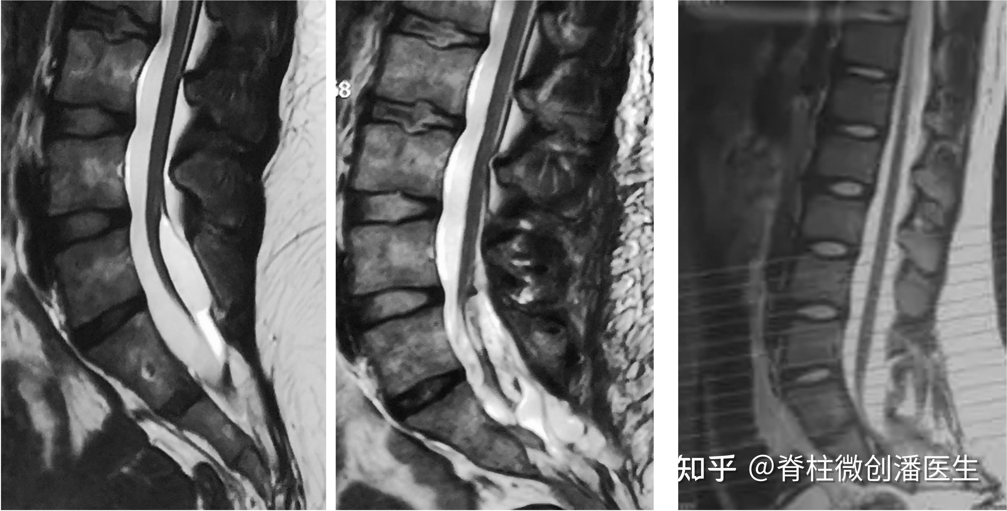 圆锥位置正常型脊髓栓系综合症_脊髓拴系综合征 - 好大夫在线