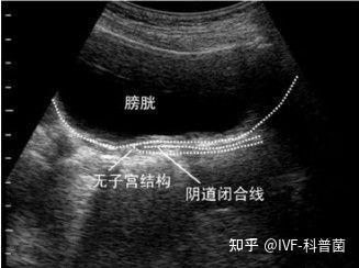 先天性无子宫石女怎么生孩子 - 知乎