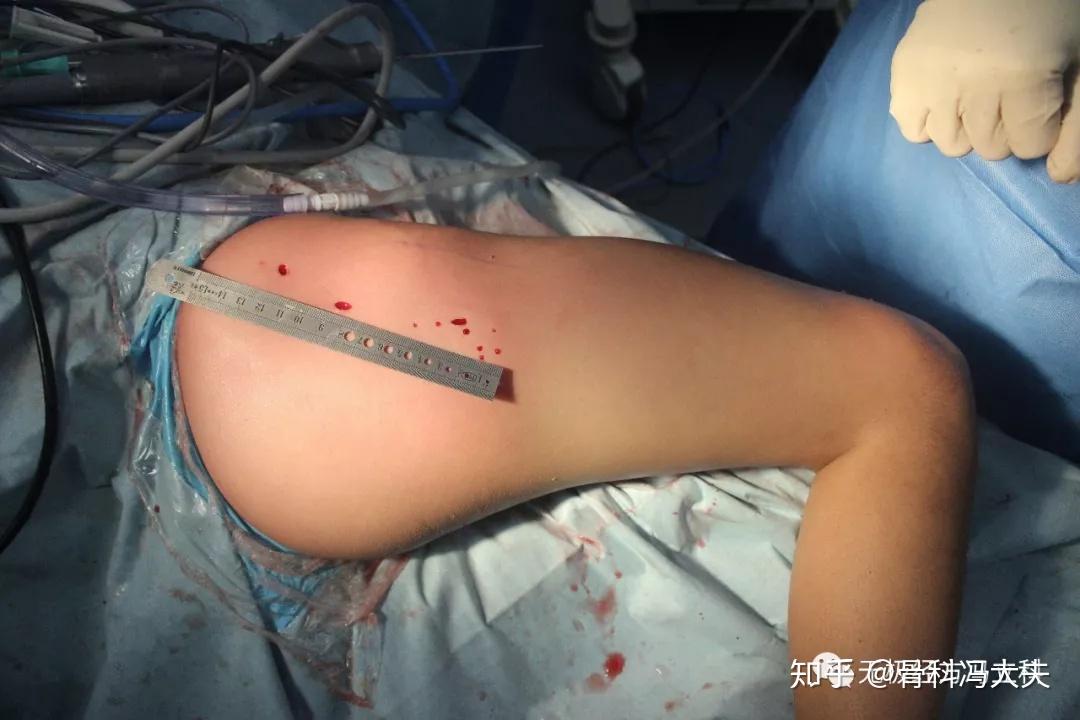 微创手术治疗臀肌挛缩症