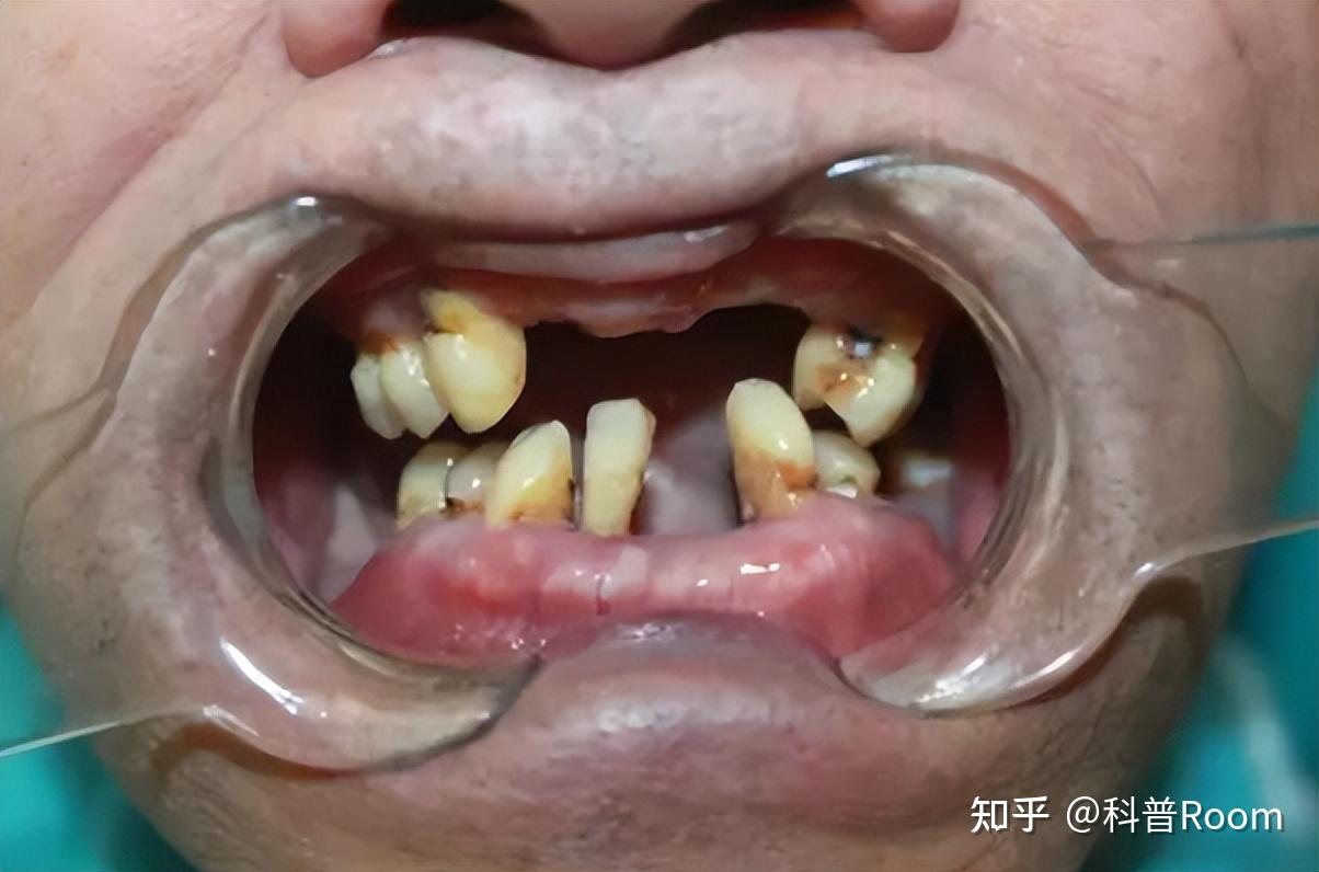 人老了都会掉牙?"老掉牙"是自然规律还是与寿命的长短有关? - 知乎