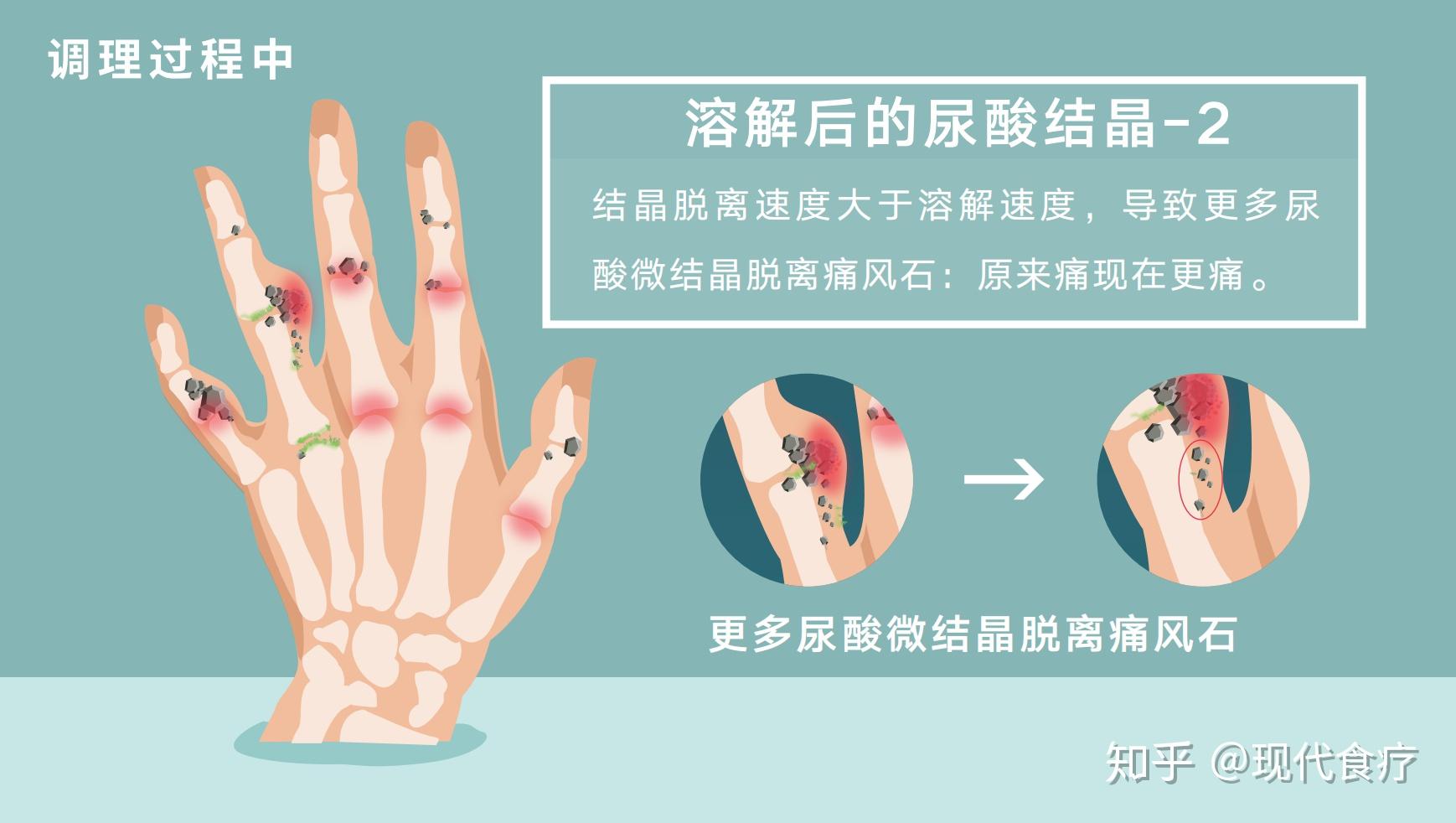 痛风调理