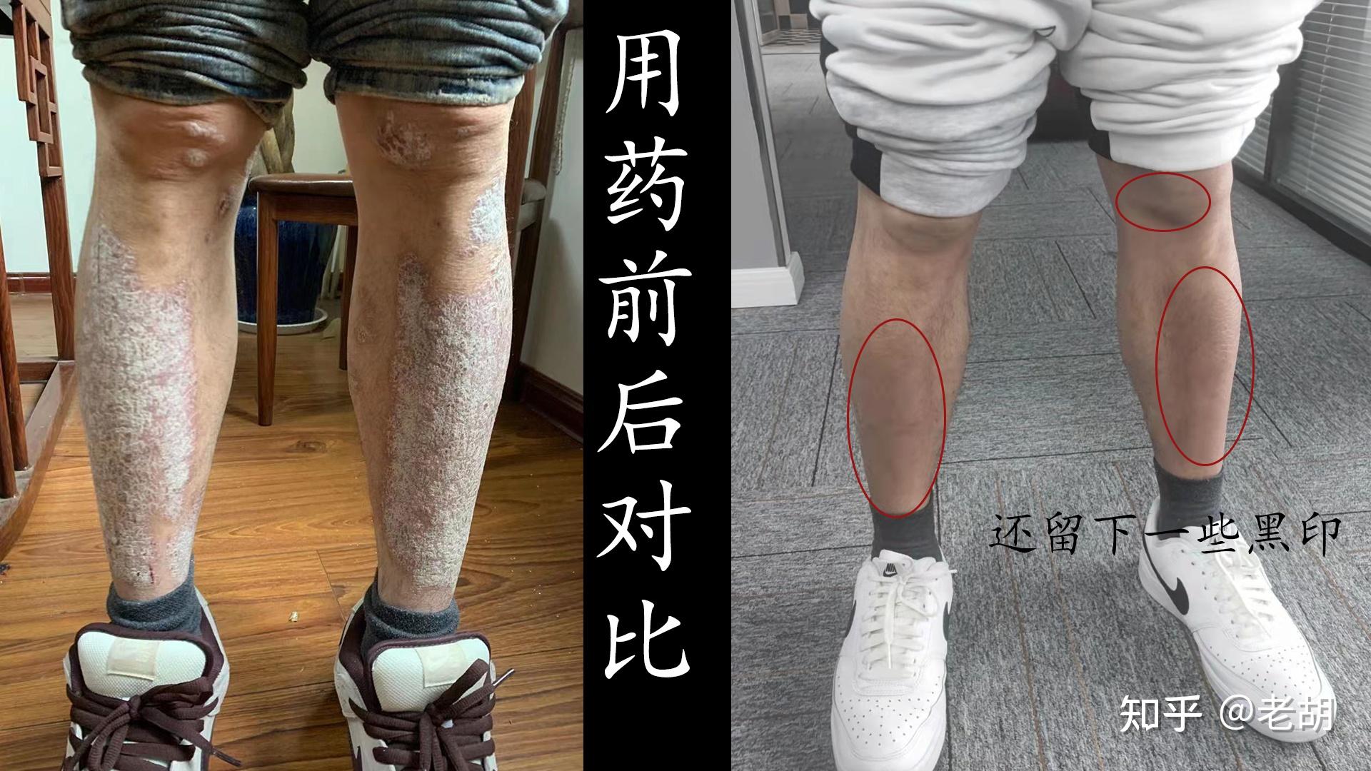 生物制剂可善挺，银屑病患者的救星 - 知乎