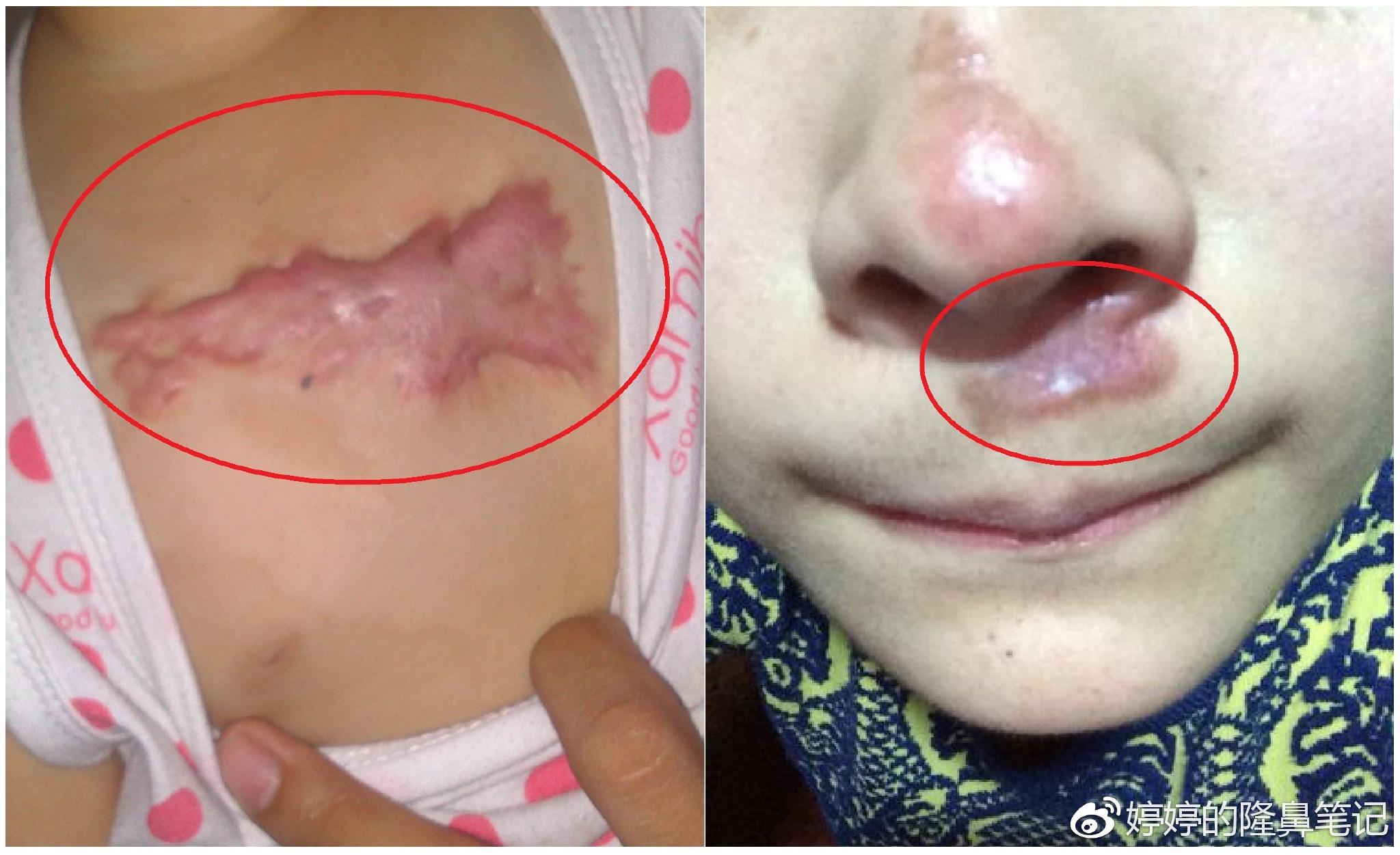 如果你属于瘢痕性体质,那也不建议做,伤口增生了,你自己也能想象出来.