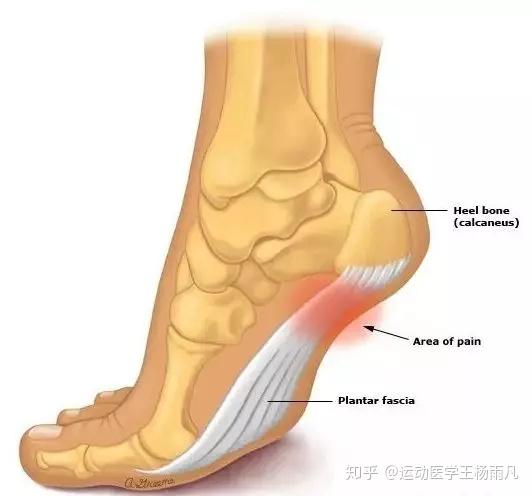 钻心之痛 十二个问题带你了解足底筋膜炎 知乎