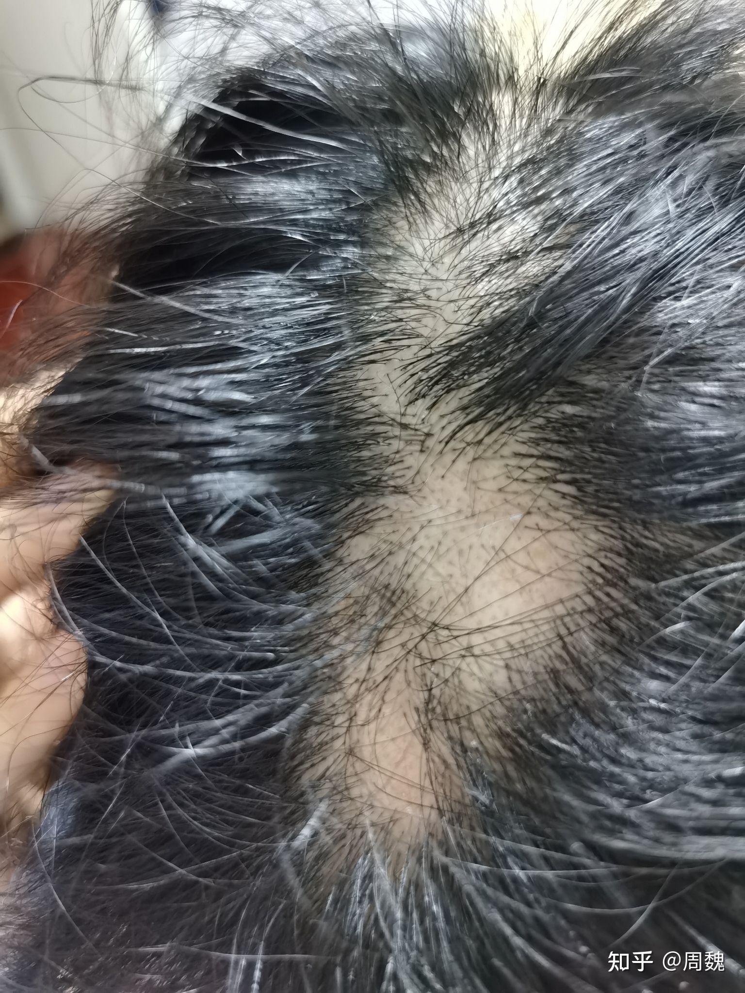 郑州皮肤科丨斑秃是什么原因造成的？怎么治疗比较好？ - 知乎