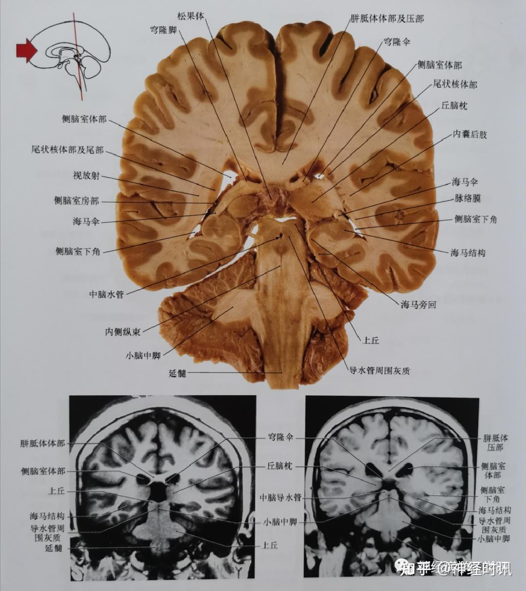 圖7 通過鬆果體,丘腦枕的尾部,上丘,腦幹被蓋,小腦中腳平面的冠狀位