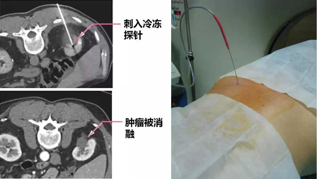 肺部的冷冻消融术简单说