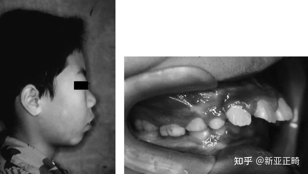 学术正畸| 错𬌗畸形的临床表现及矫治方式 - 知乎