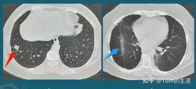 这2种肺结节,极易发展成肺癌!