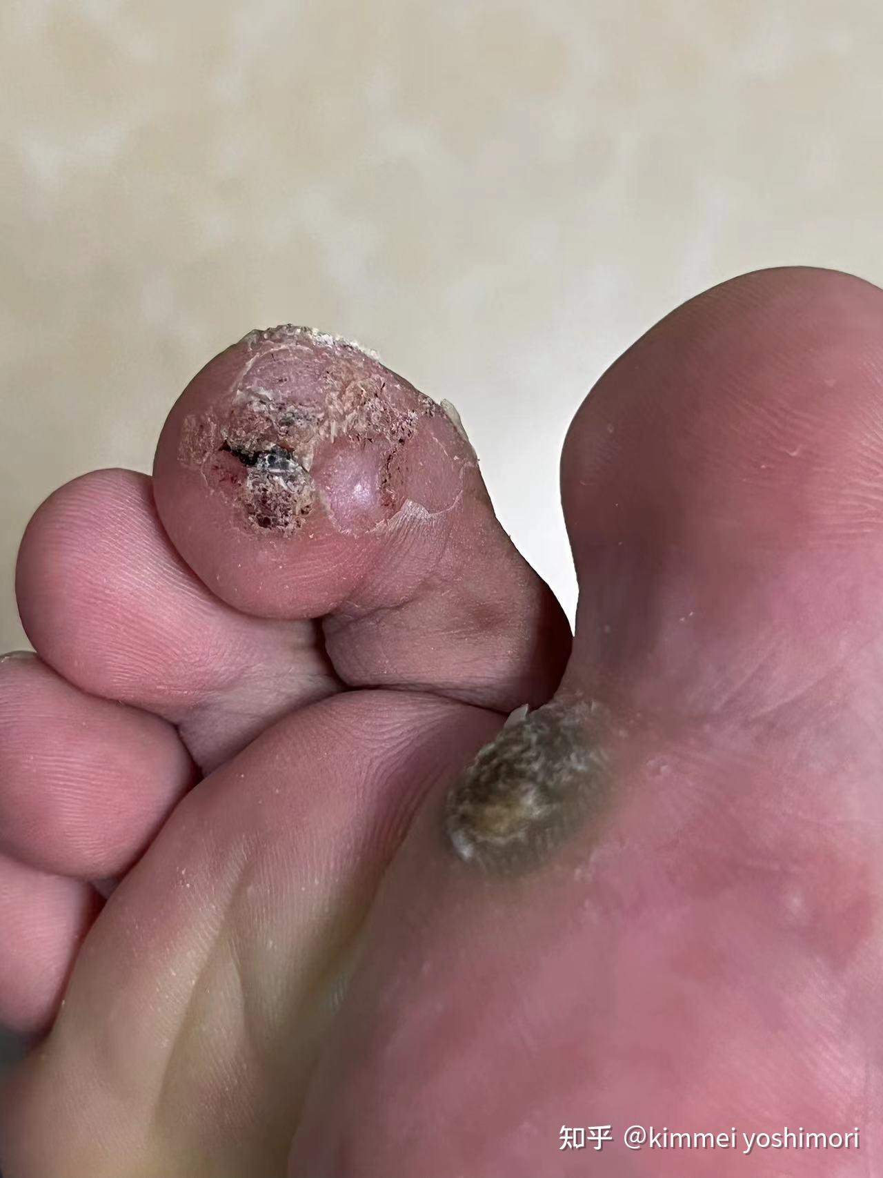 大家可以参照,通过4次针水和一次放射光治疗后 痊愈.