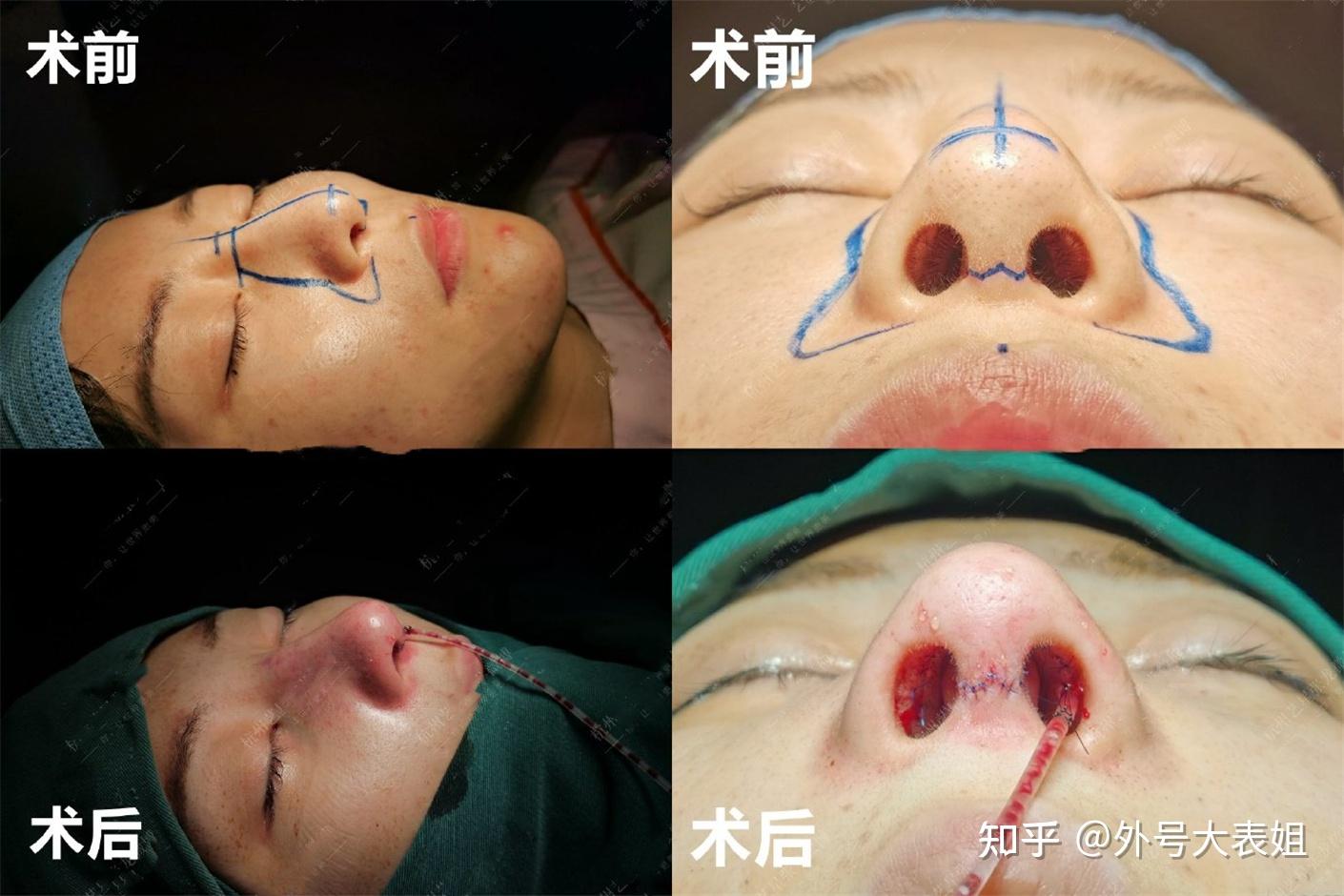 杭州隆鼻修复医生哪家强隆鼻失败高难度案例一览