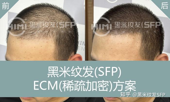 植发和纹发哪个靠谱？全面解析适用人群与效果，帮你做出最佳选择 - 知乎