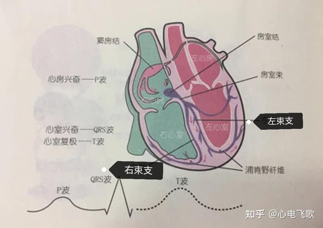 什么是各种完全性右束支阻滞或左束支阻滞及分支阻滞心电图？要不要紧！ - 知乎