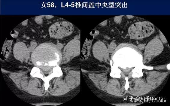 腰椎ct诊断：椎间盘突出、椎管狭窄、退行性改变 知乎