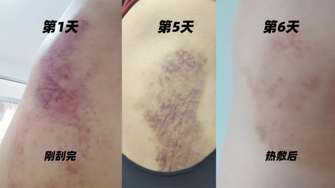 刮痧|第二次刮痧就刮出了黑包~ - 知乎