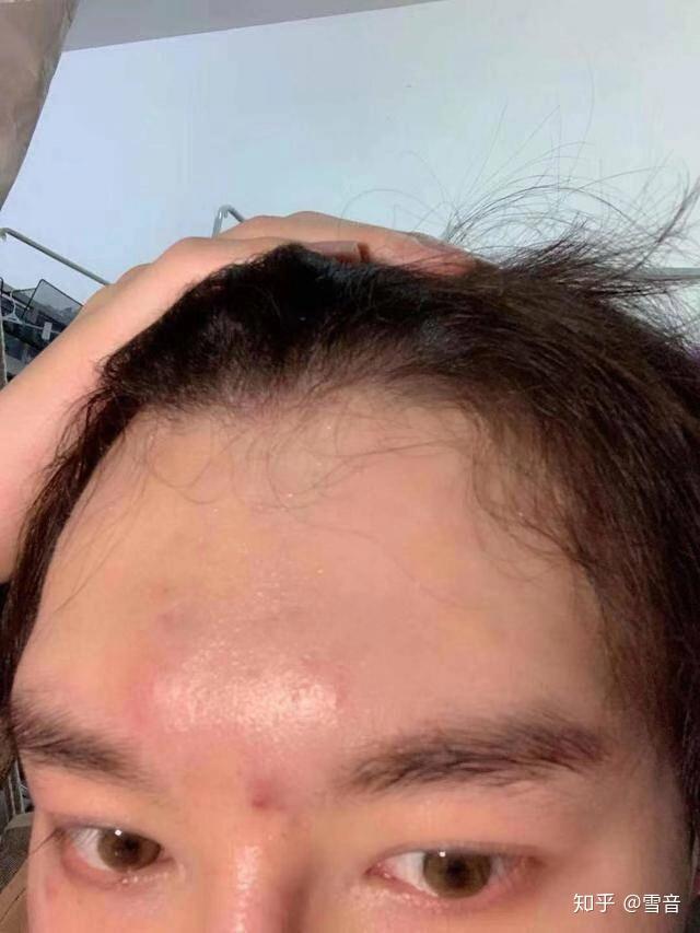 垫眉弓的假体安全吗?