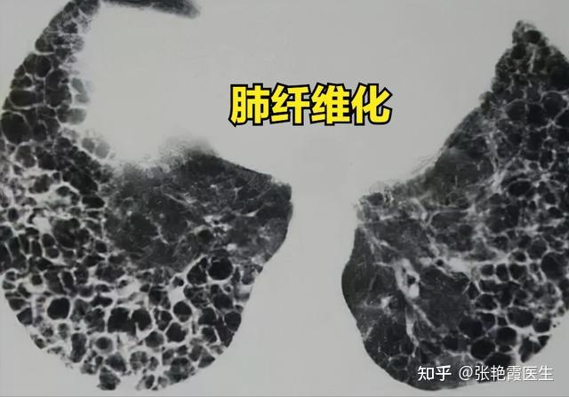 肺纤维化图片解剖图图片