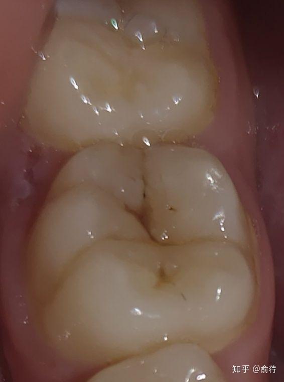 大牙上有浅色的黑线是怎么回事?是蛀牙吗?