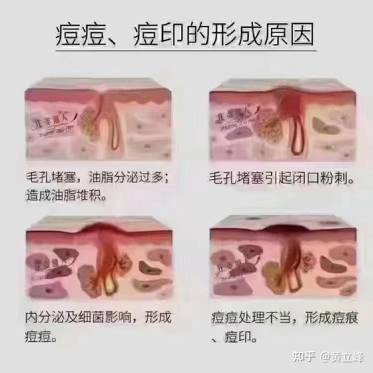 痘印颜色变化过程图片