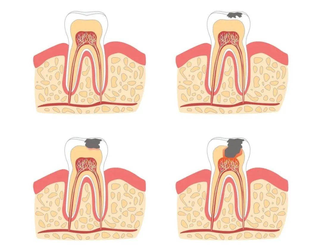 蛀牙会传染！牙医警告：亲吻、喂食、共用牙刷都有风险 - 美豆芽食物趋势
