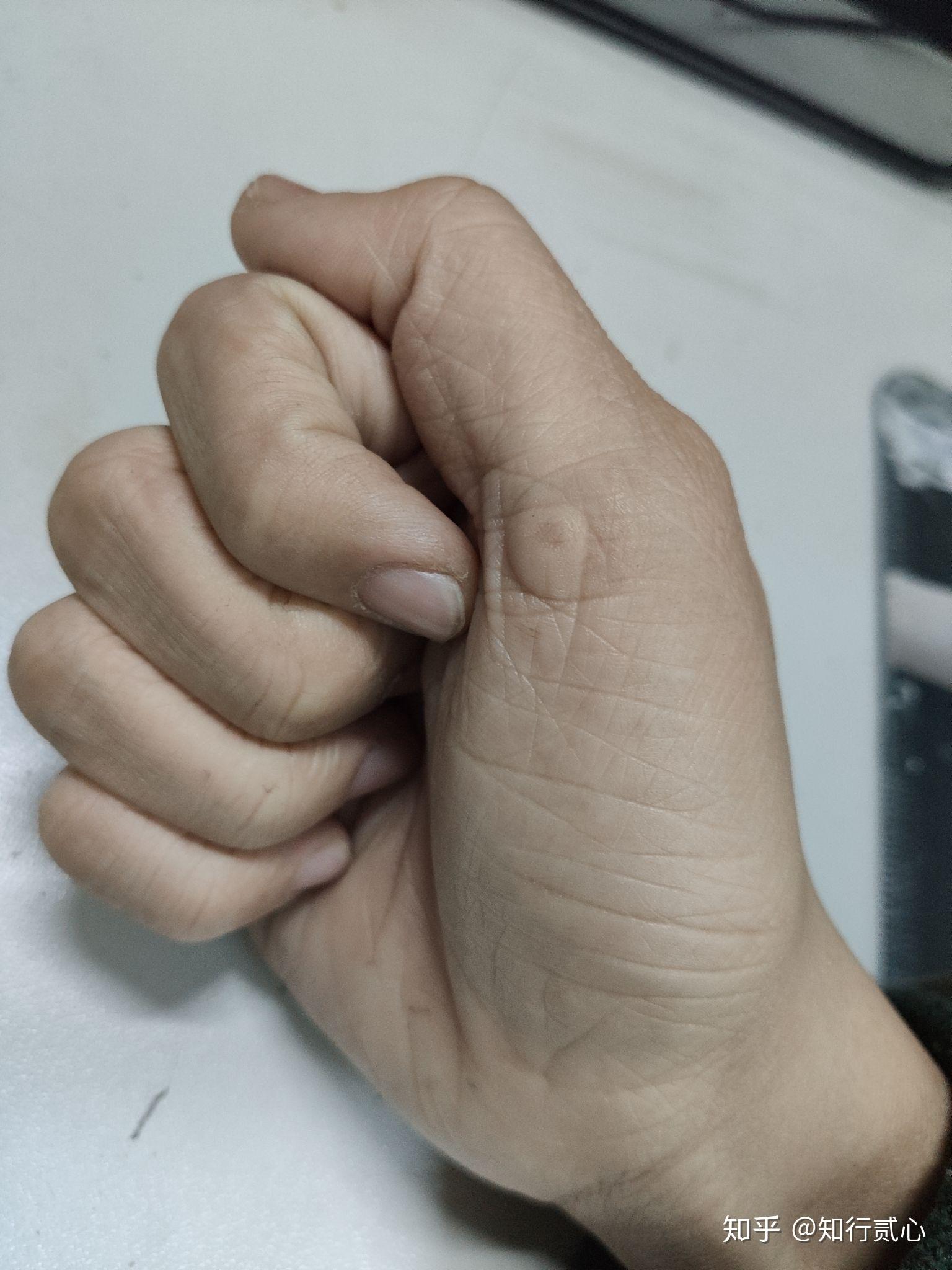 一只手有六个手指是种怎样的体验?