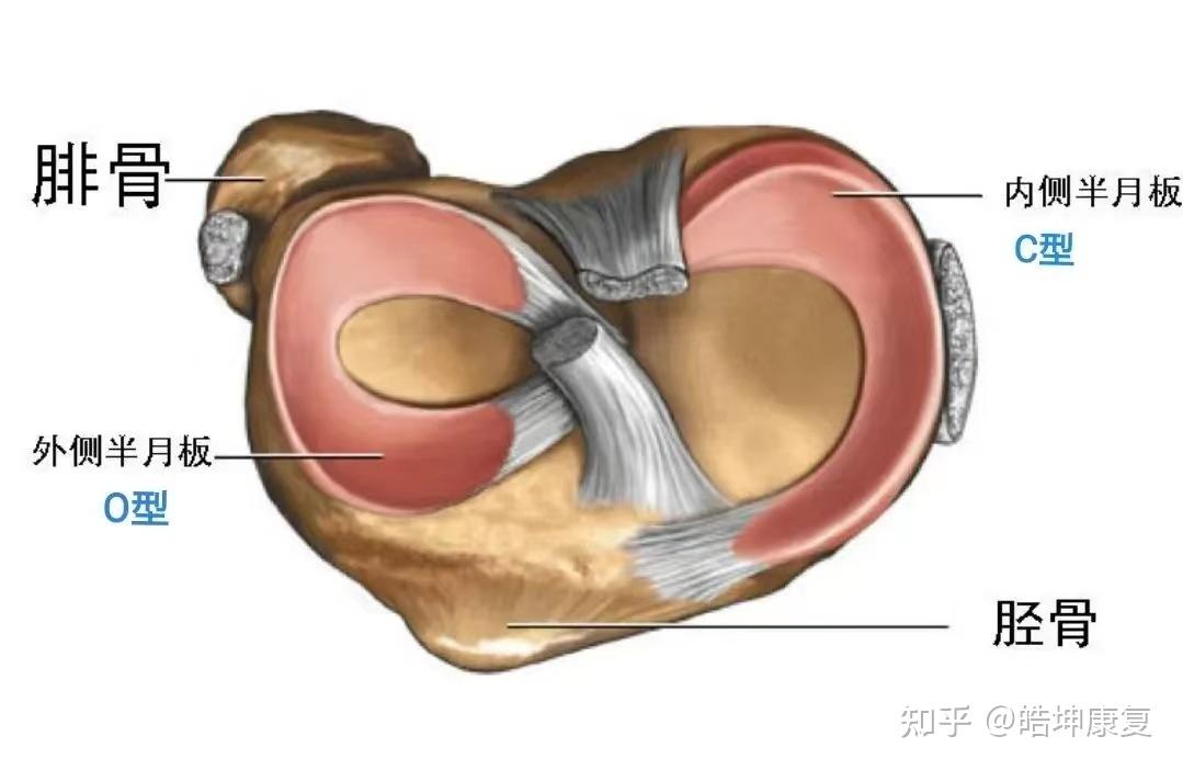 外侧半月板腘肌腱裂孔图片