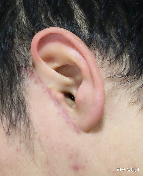 髁突骨折术后,面瘫 - 知乎