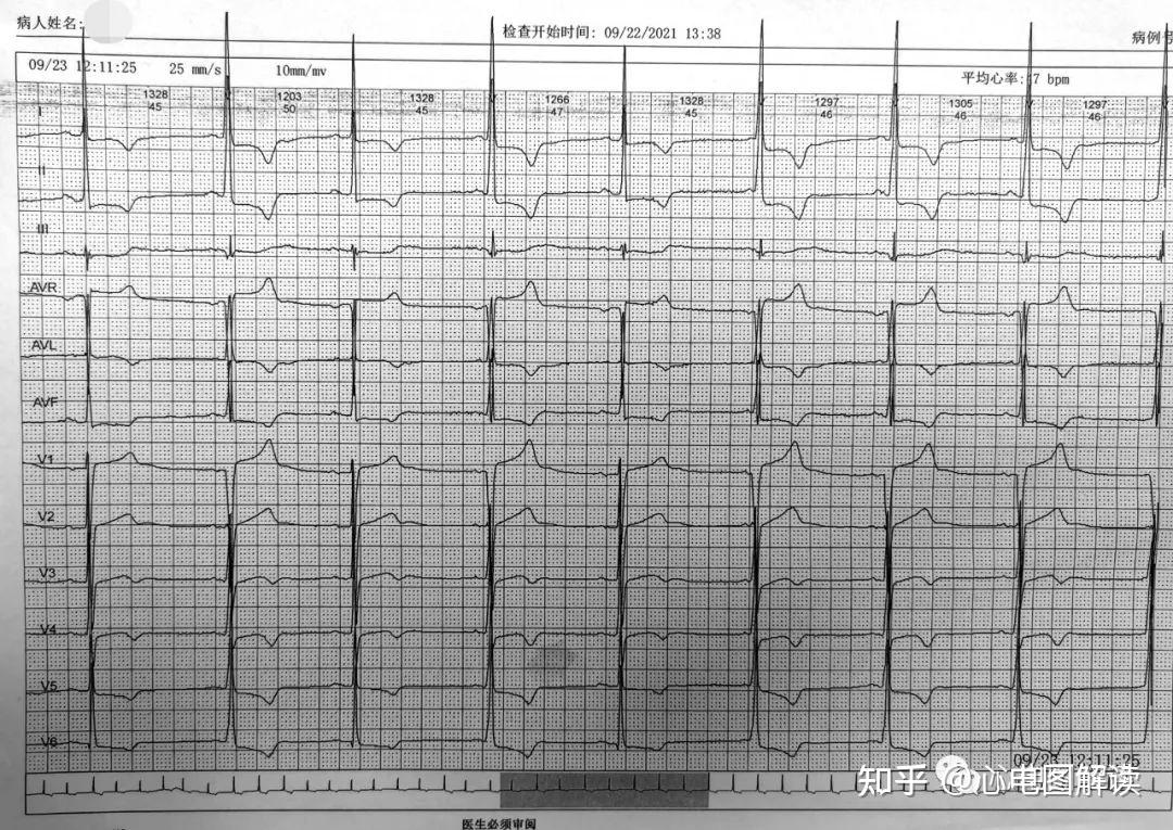 室上性心律心电图特征图片