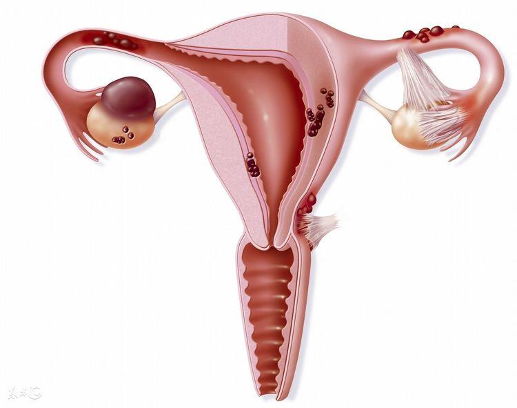 中医专家提醒卵巢囊肿若达到了这个标准不用做手术也能治好