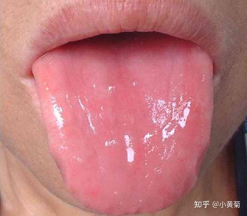 阴虚证(虚热证)典型舌象特征 - 知乎