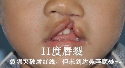 先天性嘴巴畸形图片图片