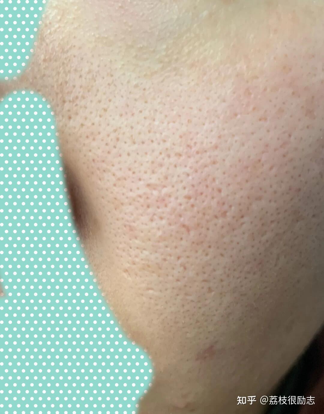 但若是油太多了,出不去,毛孔就会被堵住堵住的毛孔会被油脂角栓撑大