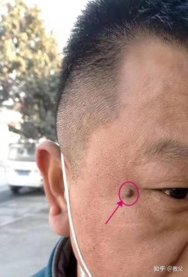 2020年5月6号状态:掉痂中状态:掉痂后总店客户:赵姐部位:右鼻翼 肉痣