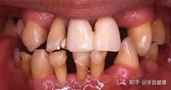 故事的结尾,就是完好无缺的牙齿,却慢慢脱落了.