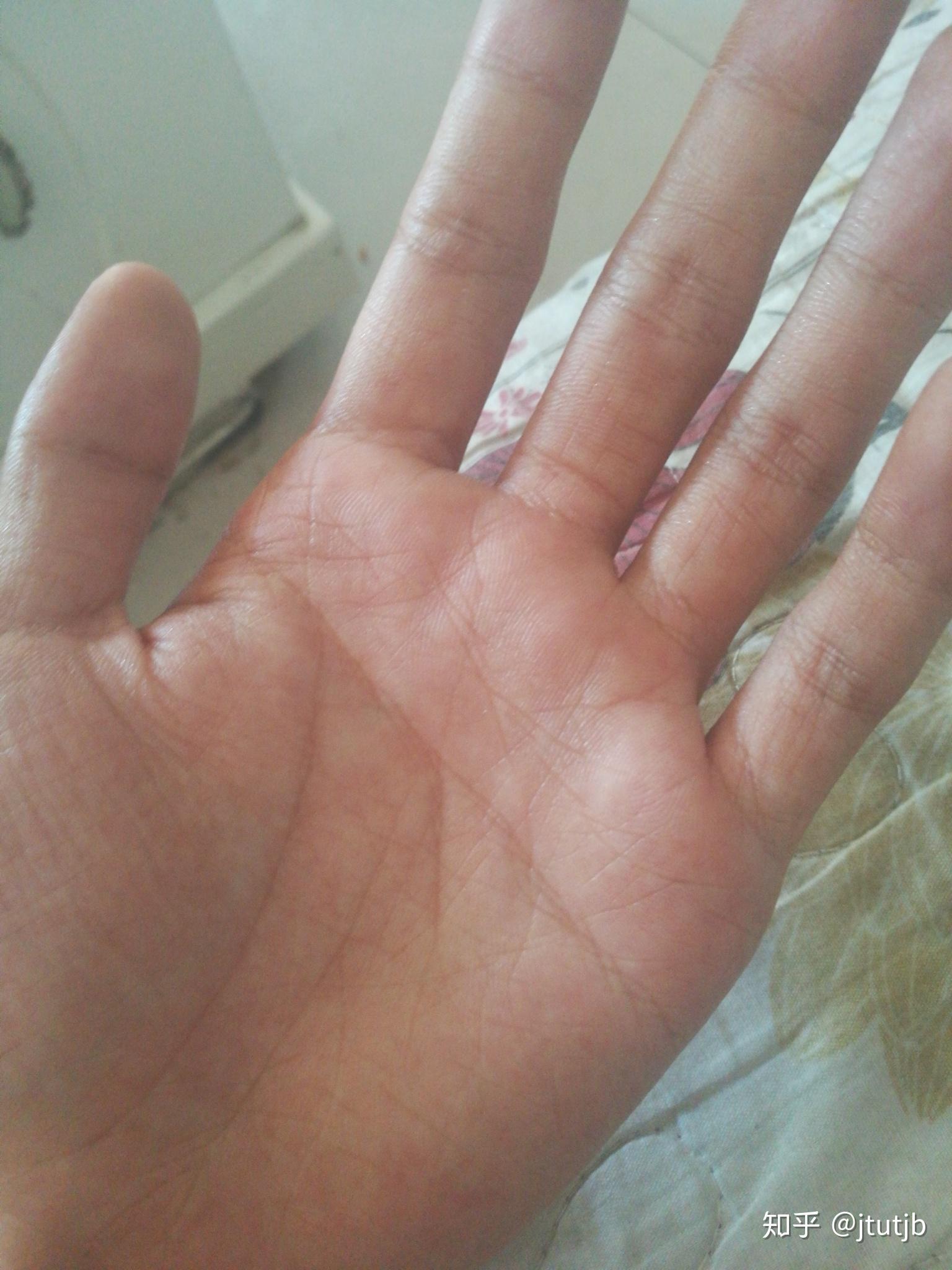 年纪轻轻20岁手上皮肤就很干有很多皱纹像老年人干瘪的手怎么办呀